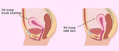 tử cung ngả sau 