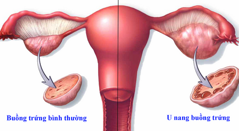 u nang buồng trứng