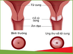 phòng ngừa ung thư cổ tử cung