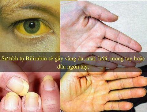 vàng da là dấu hiệu bệnh gì