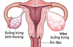 viêm buồng trứng 