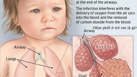 viêm phổi ở trẻ nhỏ