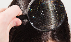 1. Dandruff 500 X 300.jpg__PID:df8dab19-b88b-4810-84a3-4163e79c22cc