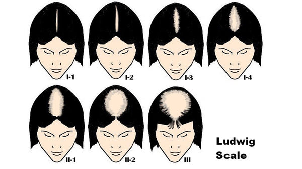 Ludwig scale of alopecia