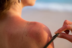 details-woman-s-sunburn-skin-from-beach-sun.jpg__PID:4bcd8eaa-9f57-4734-ab21-4816888f5d98