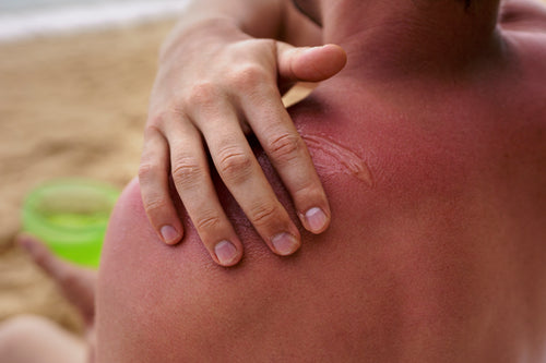 view-man-applying-lotion-sunburn-skin-beach.jpg__PID:f9063e68-bce7-4ba0-a38c-a00088082ad5