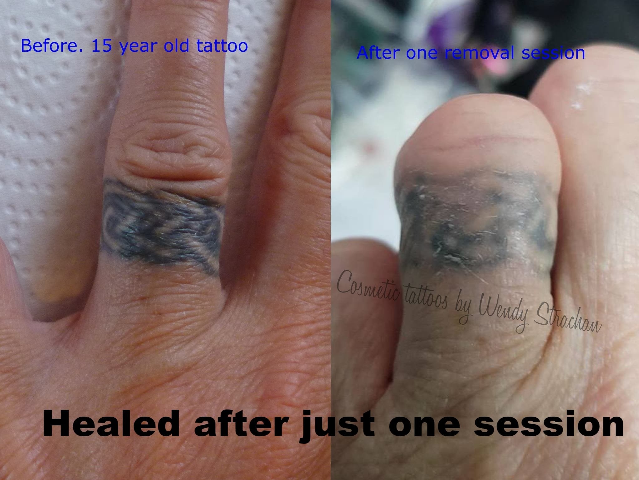 Understanding Laser Tattoo Removal  Skin Survival Laser Clinic Liverpool