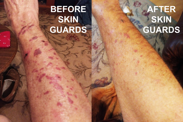 skin guards before and after thin skin covers