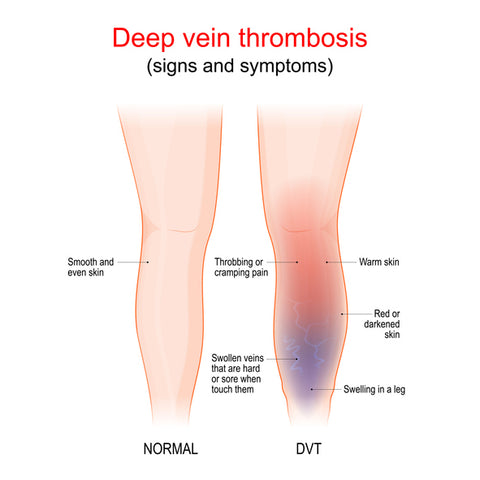 DVT - Deep Vein Thrombosis - The Natural Athletes Clinic