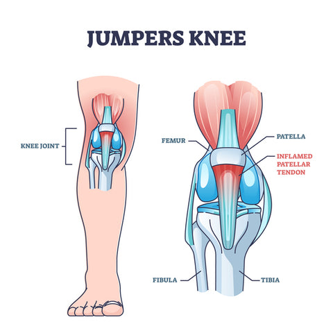 Patellar Tendonitis - The Natural Athletes Clinic