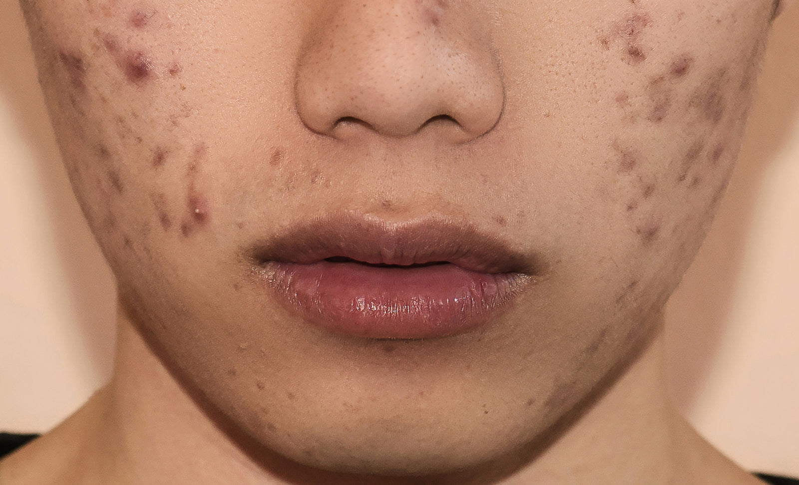 Acne Scar Picture 1600x ?v=1551381574