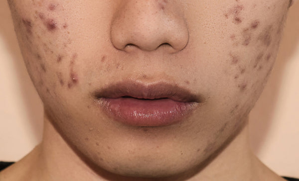 How To Remove Black Acne Marks Naturally