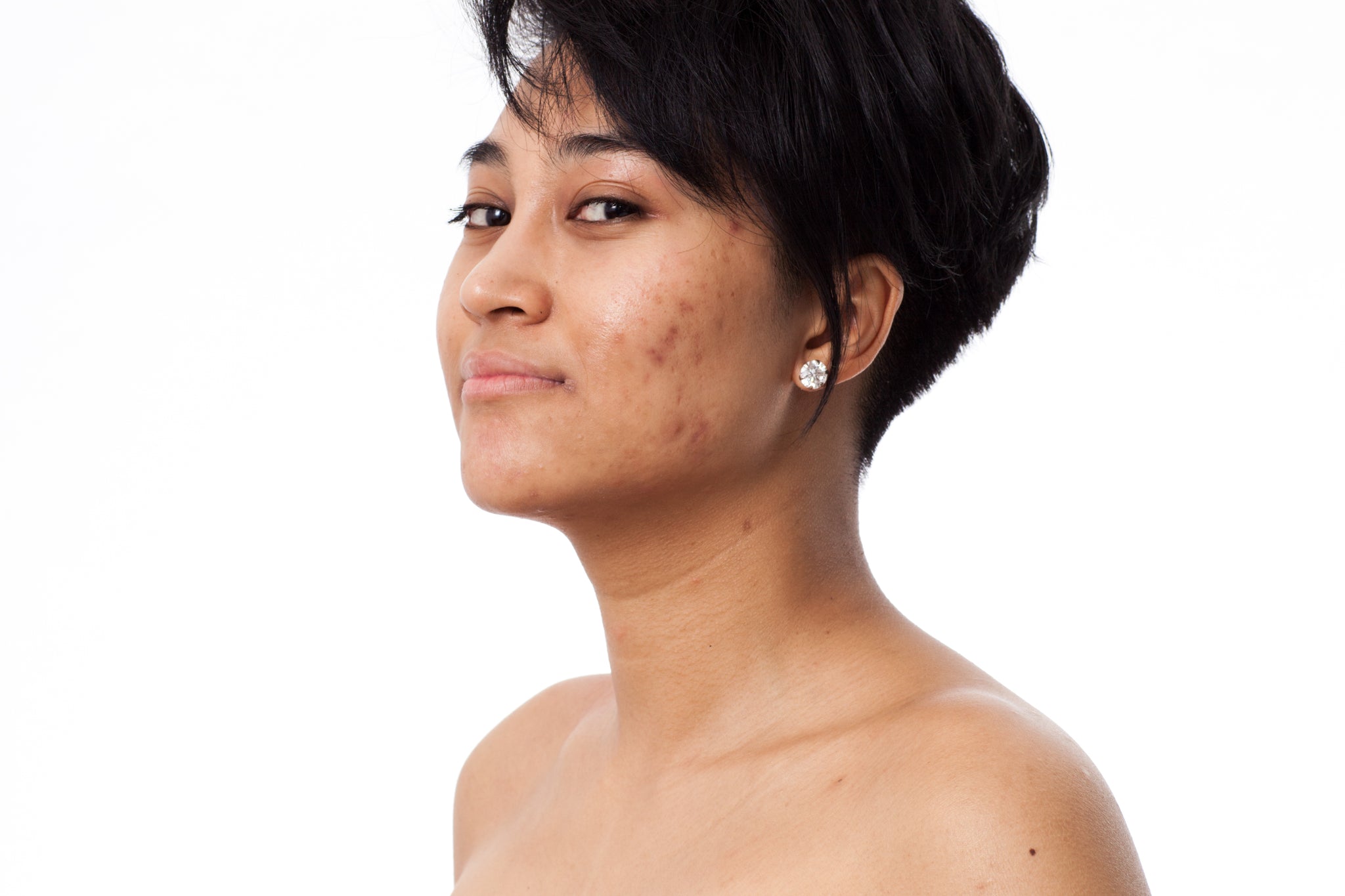 How Do I Treat Dark Spots and Hyperpigmentation on The Face? - Tonique