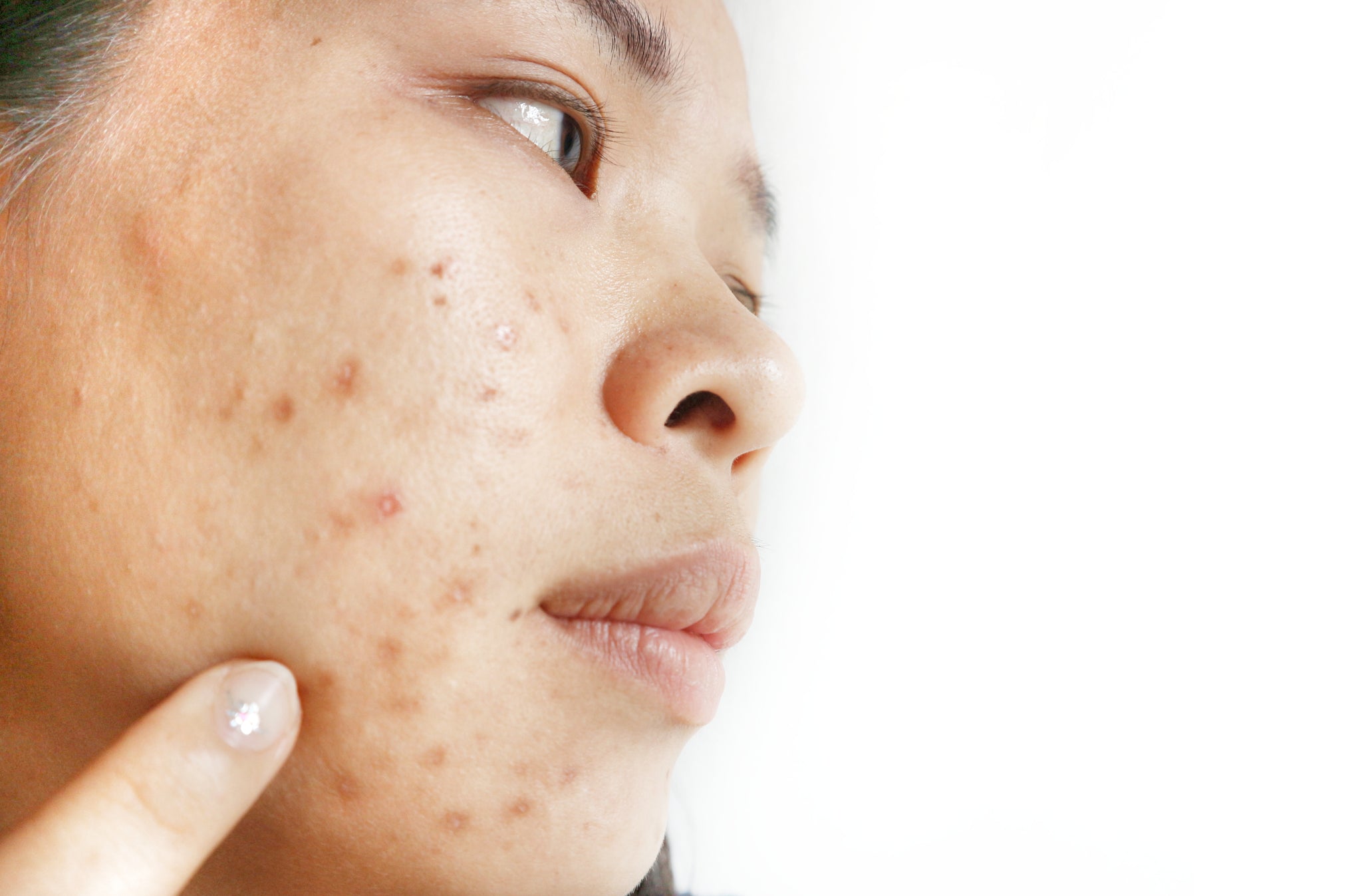 can-pigmentation-hyperpigmentation-be-removed-from-the-skin