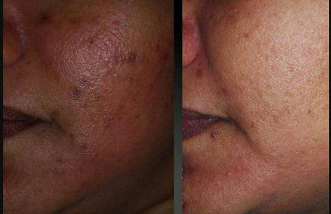 melasma removal