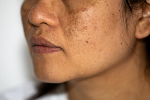 woman with blemishes, dark marks