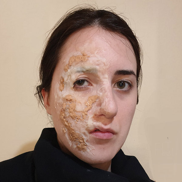 healed burn scars face