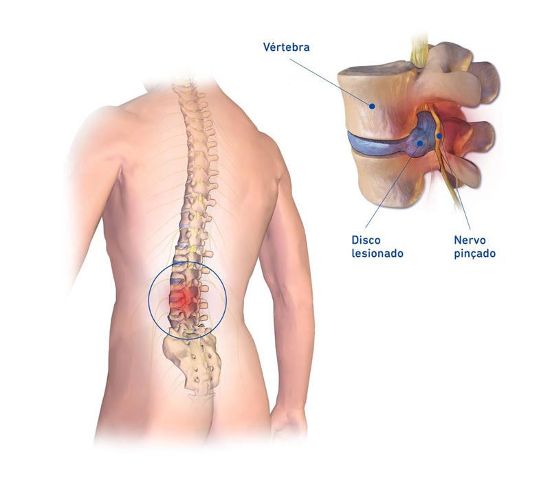 Hérnia de disco, o que causa a hérnia de disco, tipos de hérnia de disco, coluna vertebral