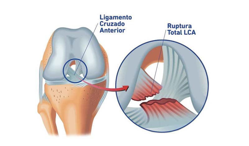 Lesão do ligamento cruzado anterior ou LCA, já ouviu falar? | Bauerfeind  Brasil