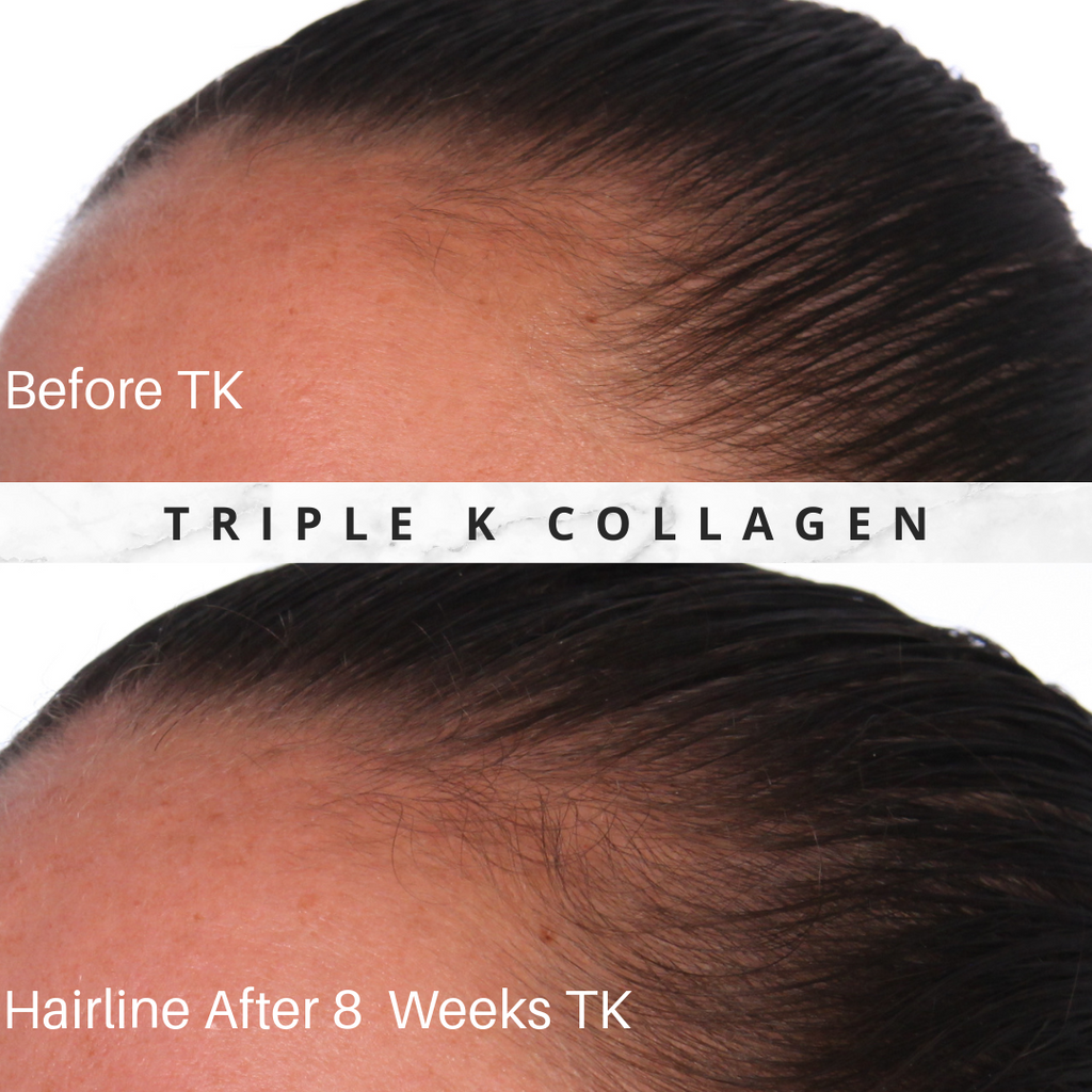 Collagen Before  After Photos  Collagen UK