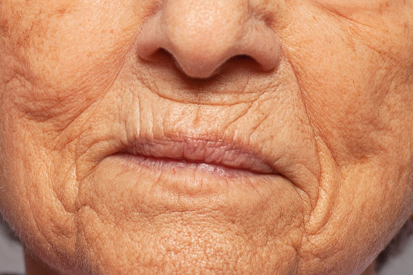 Lines and Wrinkles in skin