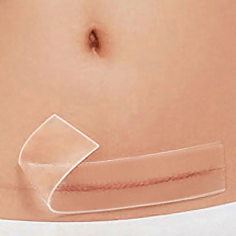 silicone scar treatment