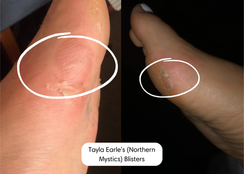 Tayla Earles Blisters