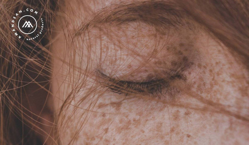 Whats The Difference Between Hyperpigmentation And Melasma Amandean