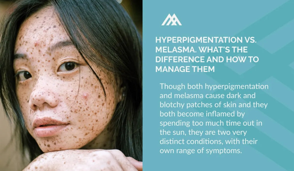 Difference between Hyperpigmentation and Melasma