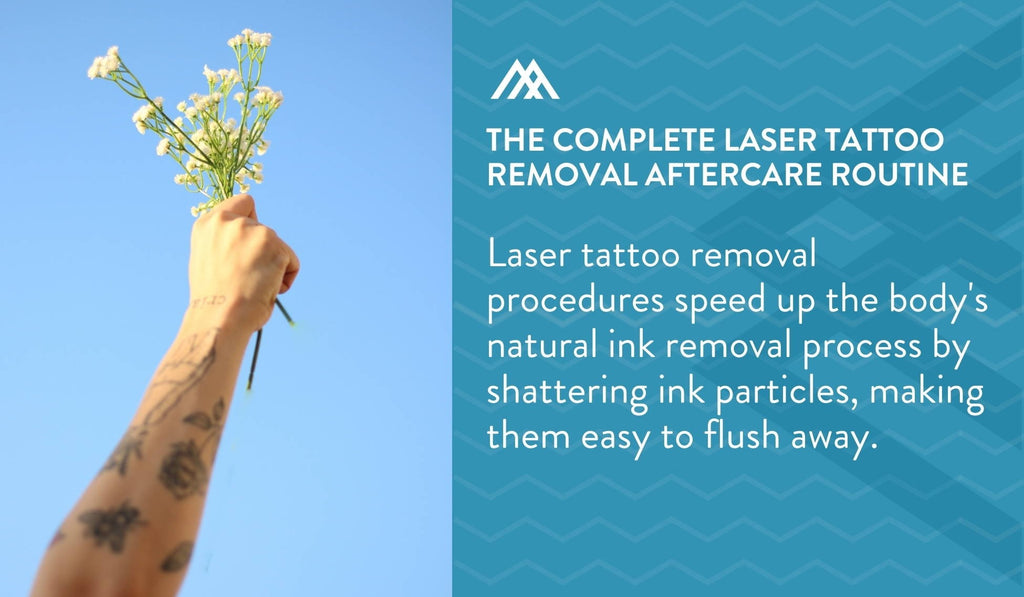 Laser tattoo removal