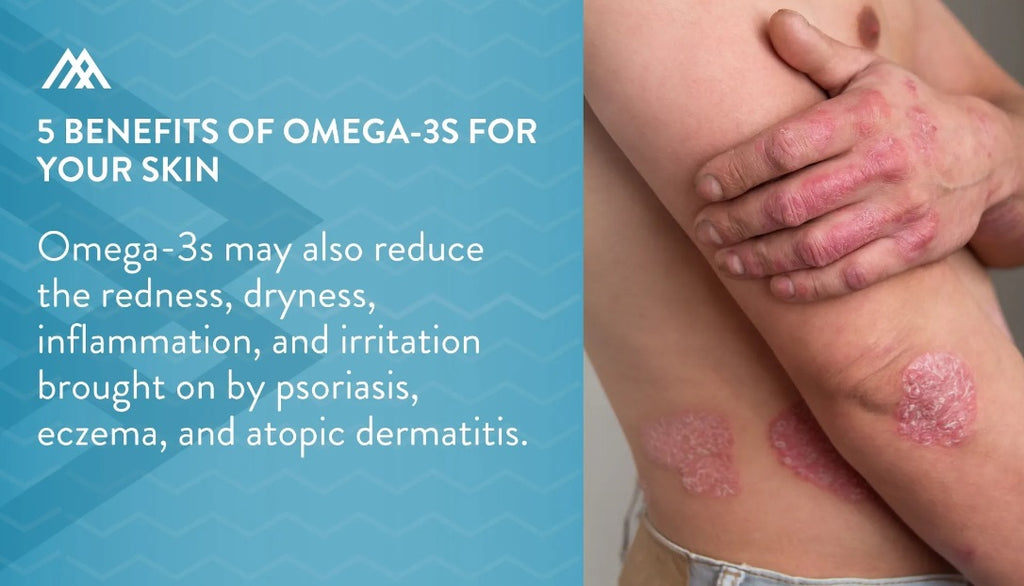 Omega-3 and acne