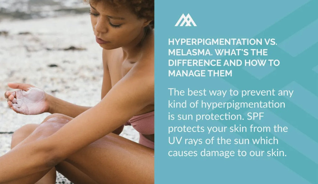 The best way to prevent any kind of hyperpigmentation is sun protection