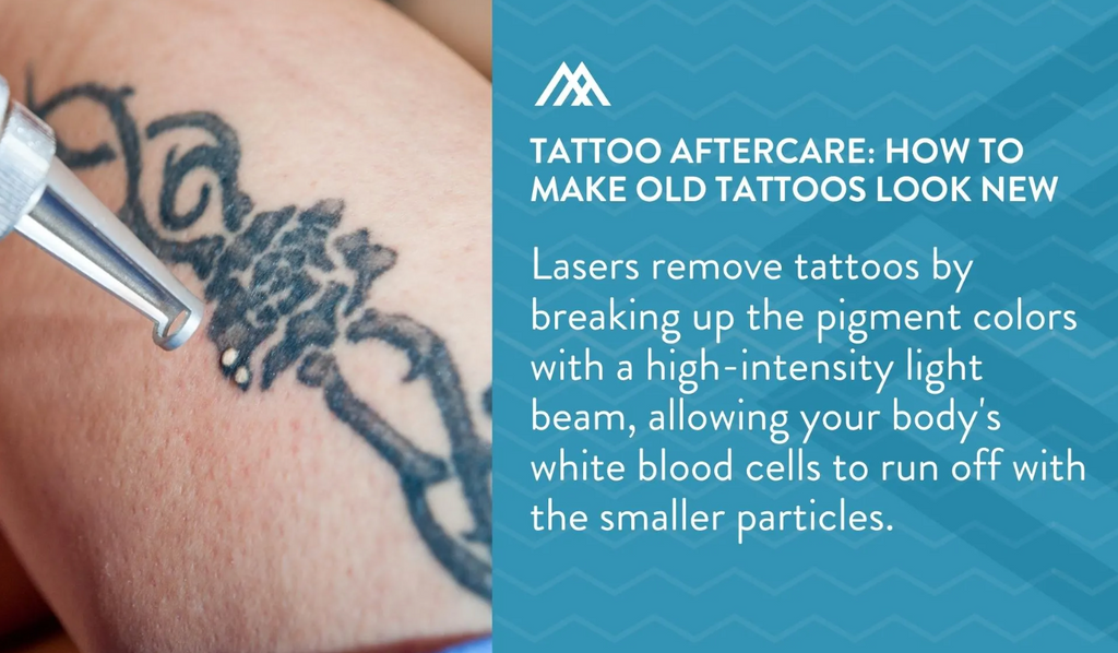 Laser tattoo removal and skincare