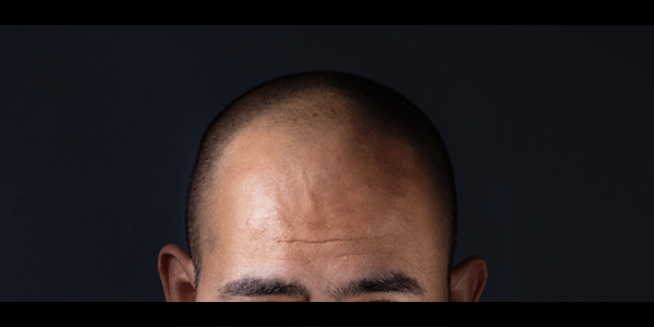 About Hair Loss: 4 Things You Need to Know