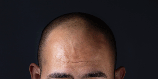 About Hair Loss: 4 Things You Need to Know