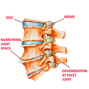 Osteoarthritis in the spine