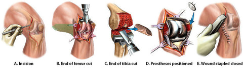 Partial and total knee replacement surgery pre-op and post-op