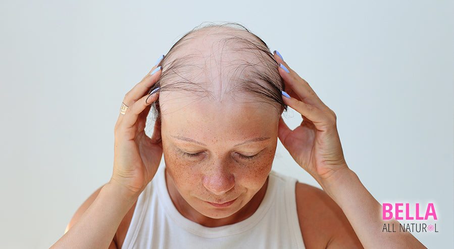 A Severe Case of Alopecia