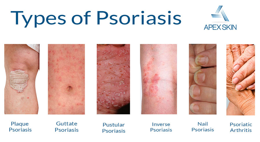 Can Psoriasis Ever Be Cured And Go Away For Good? – Bella All Natural