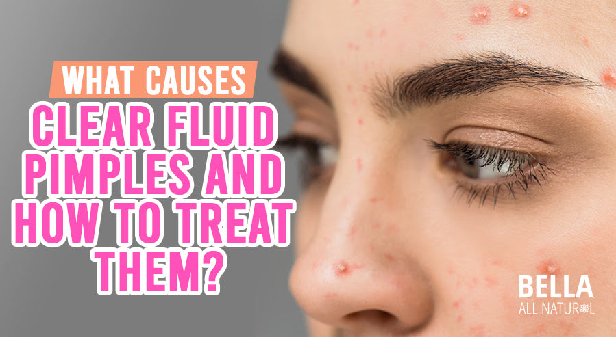 What Causes Clear Fluid Pimples