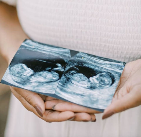 A woman holds two baby ultrasounds to announce a twin pregnancy