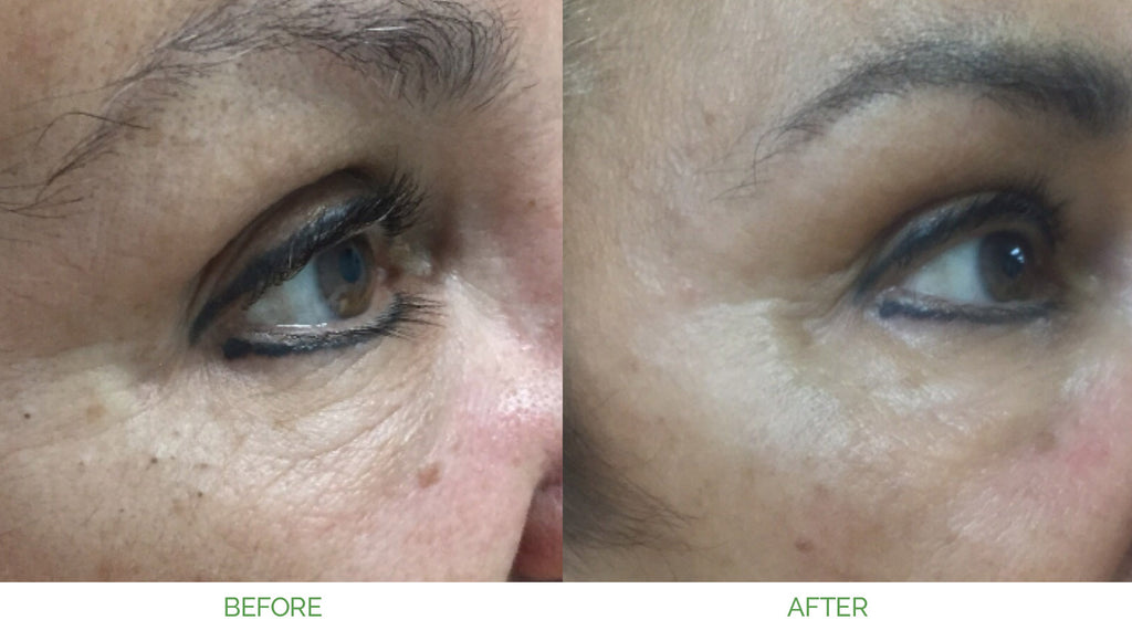 MD Pen Skin Rejuvenation With MicroNeedling on the EC! 