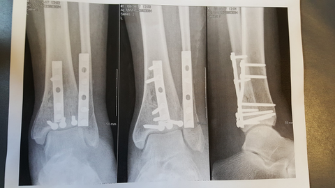 X-ray of Erin's broken leg