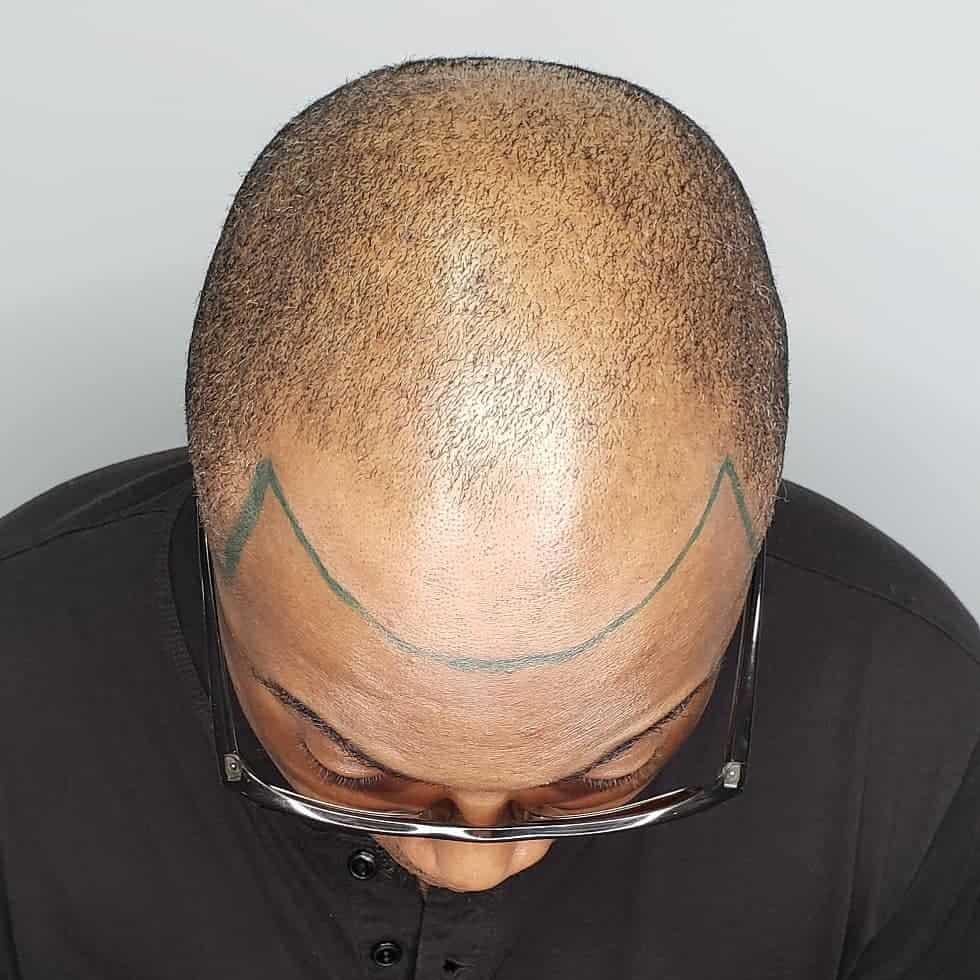 Scalp Micropigmentation