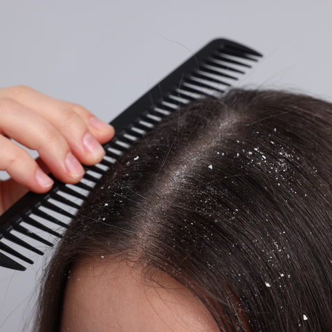 The Impact of an Unhealthy Scalp on Hair Growth