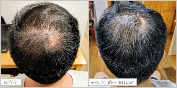 Before and result after 90 days usingKérastase's Densifique Cure Homme