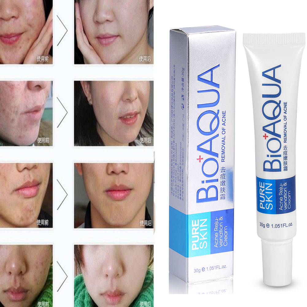 Bioaqua - Removedor De Acne - 30gr – Beauty Store Peru