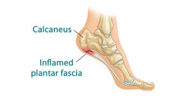 footlogics plantar fasciitis