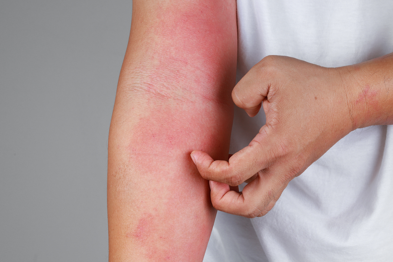 Healing inflammation associated with eczema atopic dermatitis
