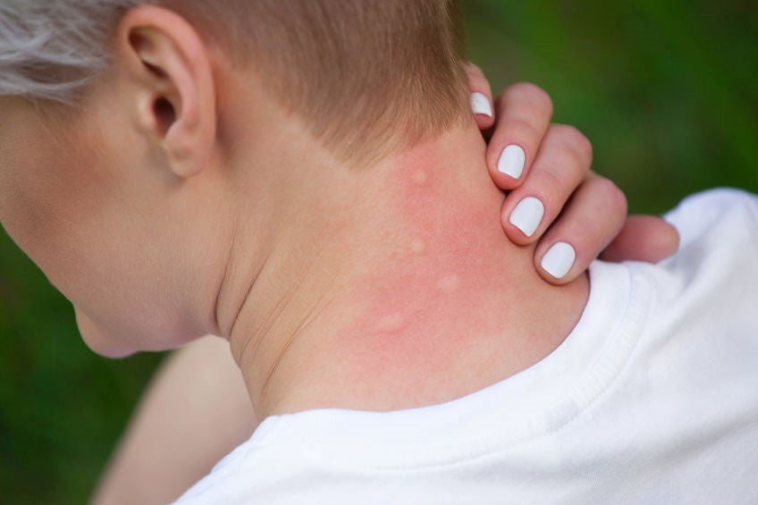 signs-you-might-be-allergic-to-mosquito-bites-mosquitonix-mosquitonix